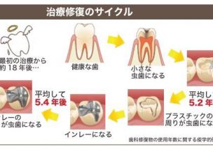 歯医者の真実 歯医者さんは実際 歯を治してあげられない という事実 神田中央通りいけむら歯科 削らない 痛くない治療の歯医者