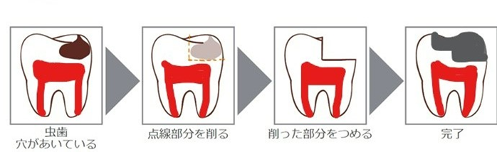 むし歯治療の行程