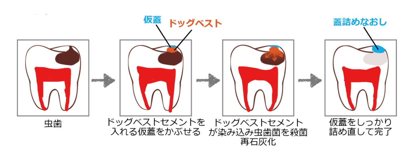 治療イメージ
