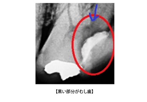 レントゲン写真