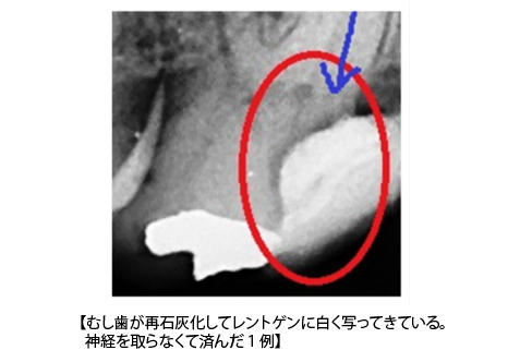 レントゲン写真